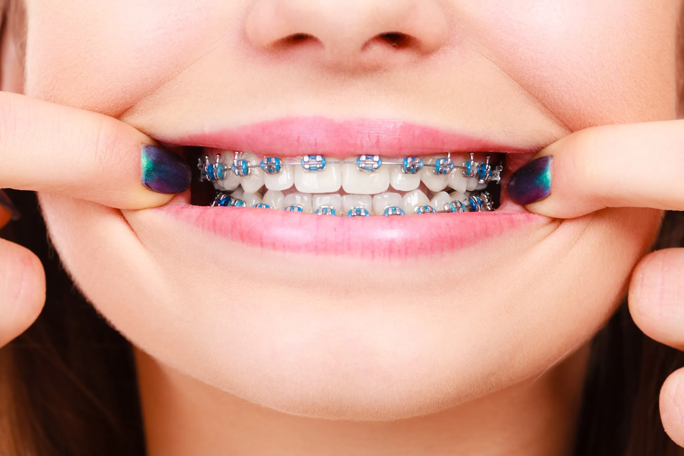 Brackets on a teenager’s upper teeth