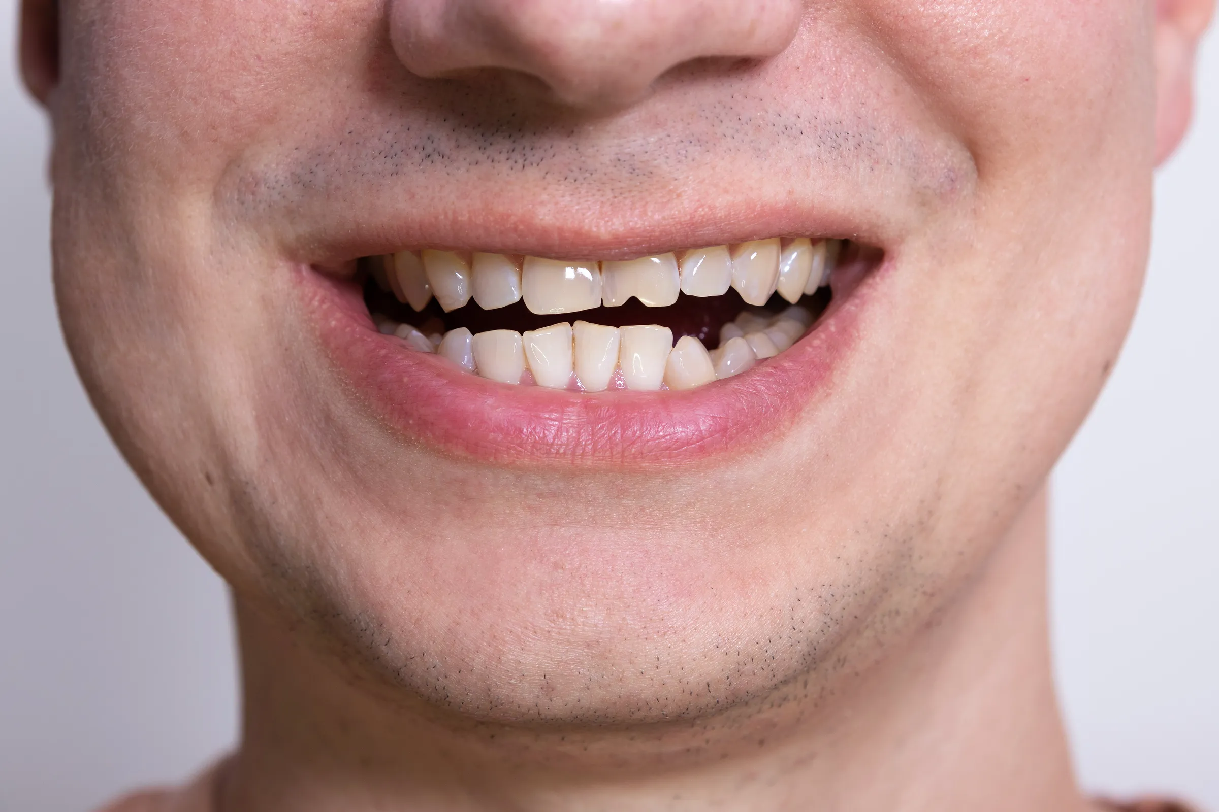 Close-up of a man's smile showing a chipped upper front tooth