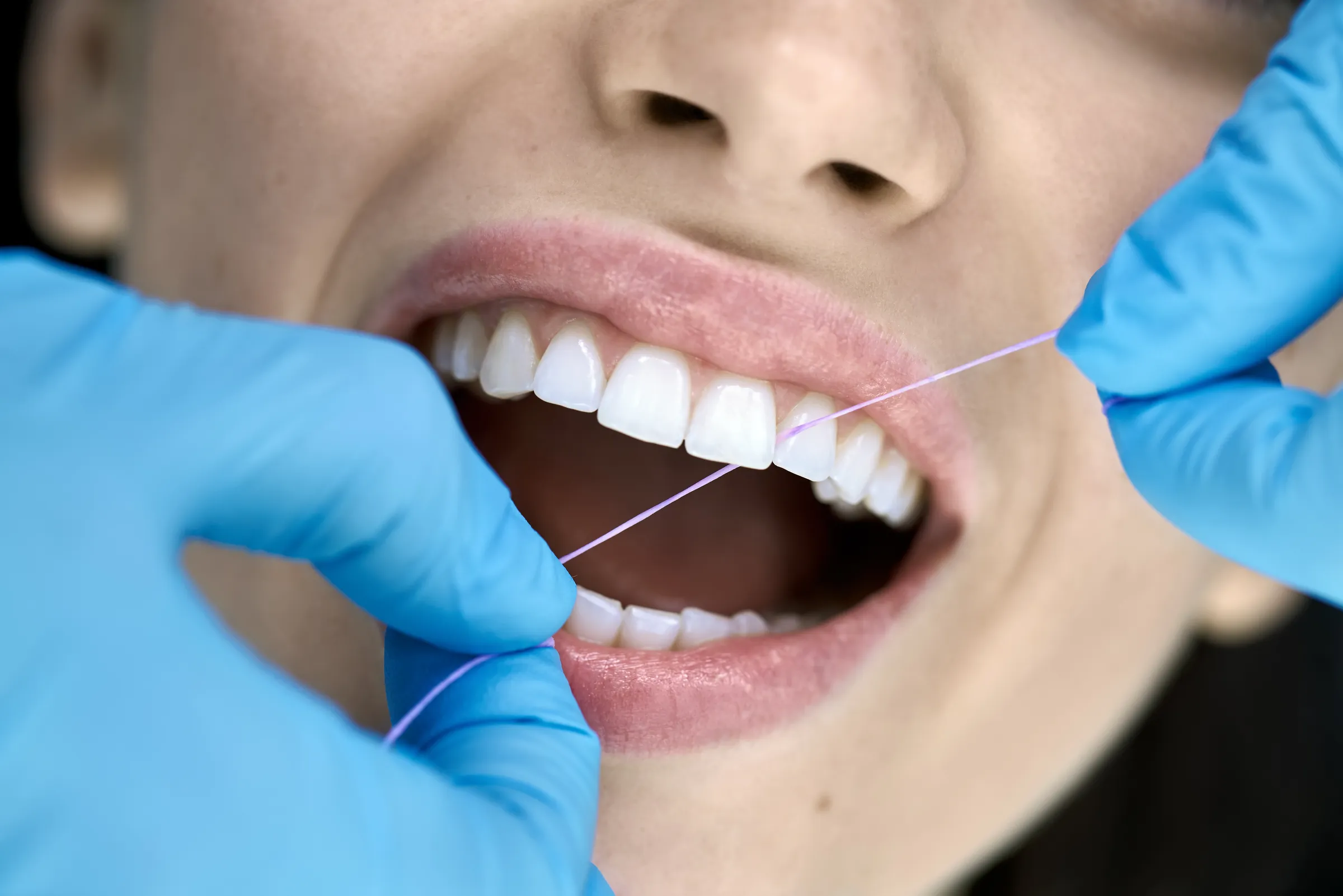 Gloved hands flossing between a patient's front teeth