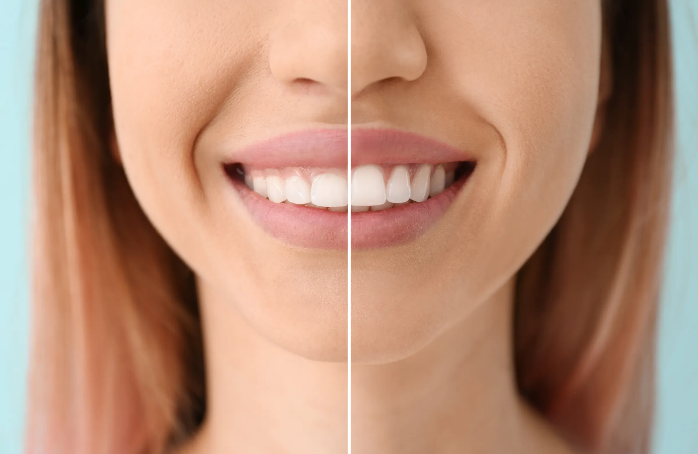 Side-by-side comparison of a smile before and after treatment