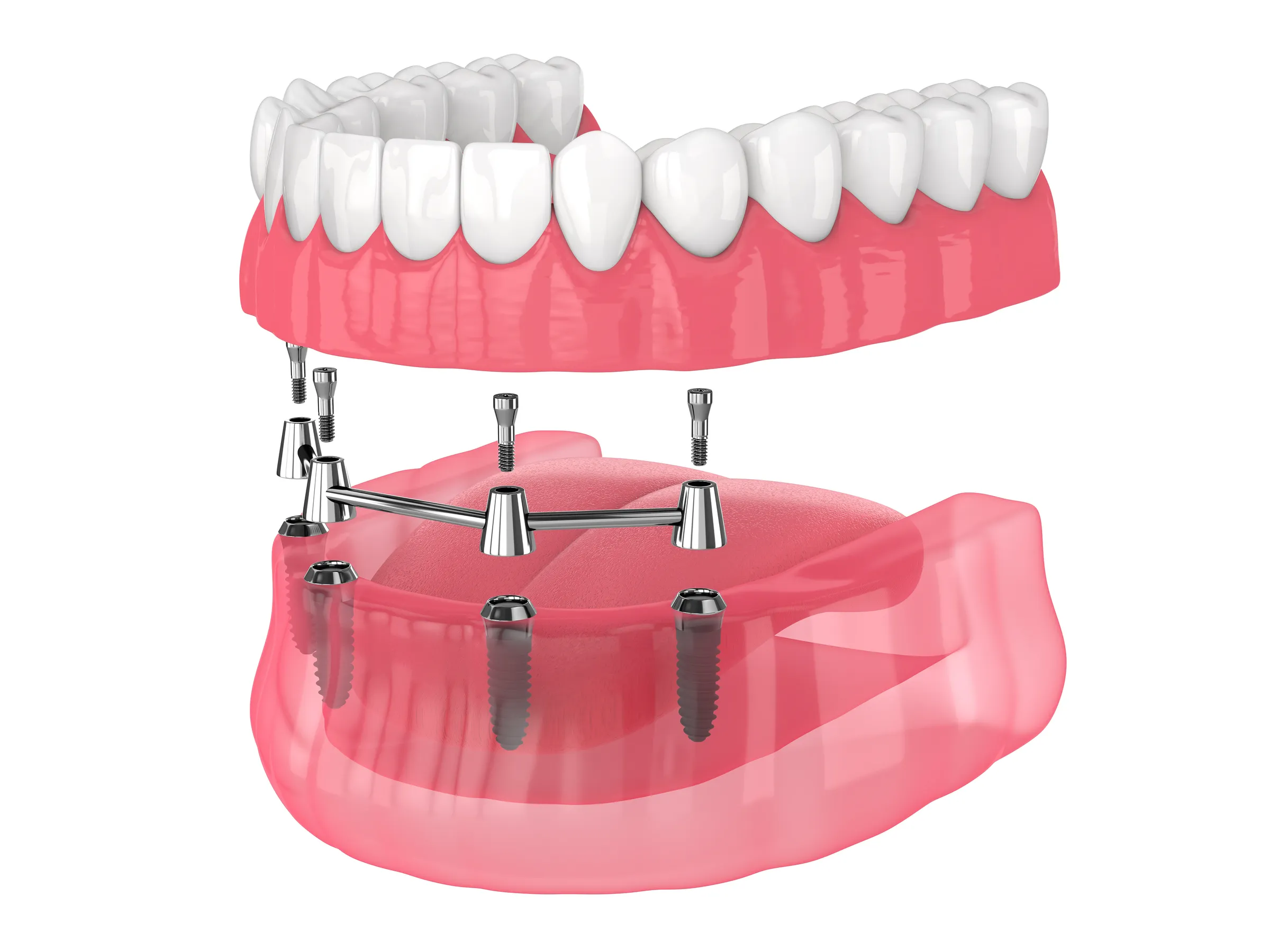 Illustration of an implant-supported denture lifted away from four implants in the lower jaw