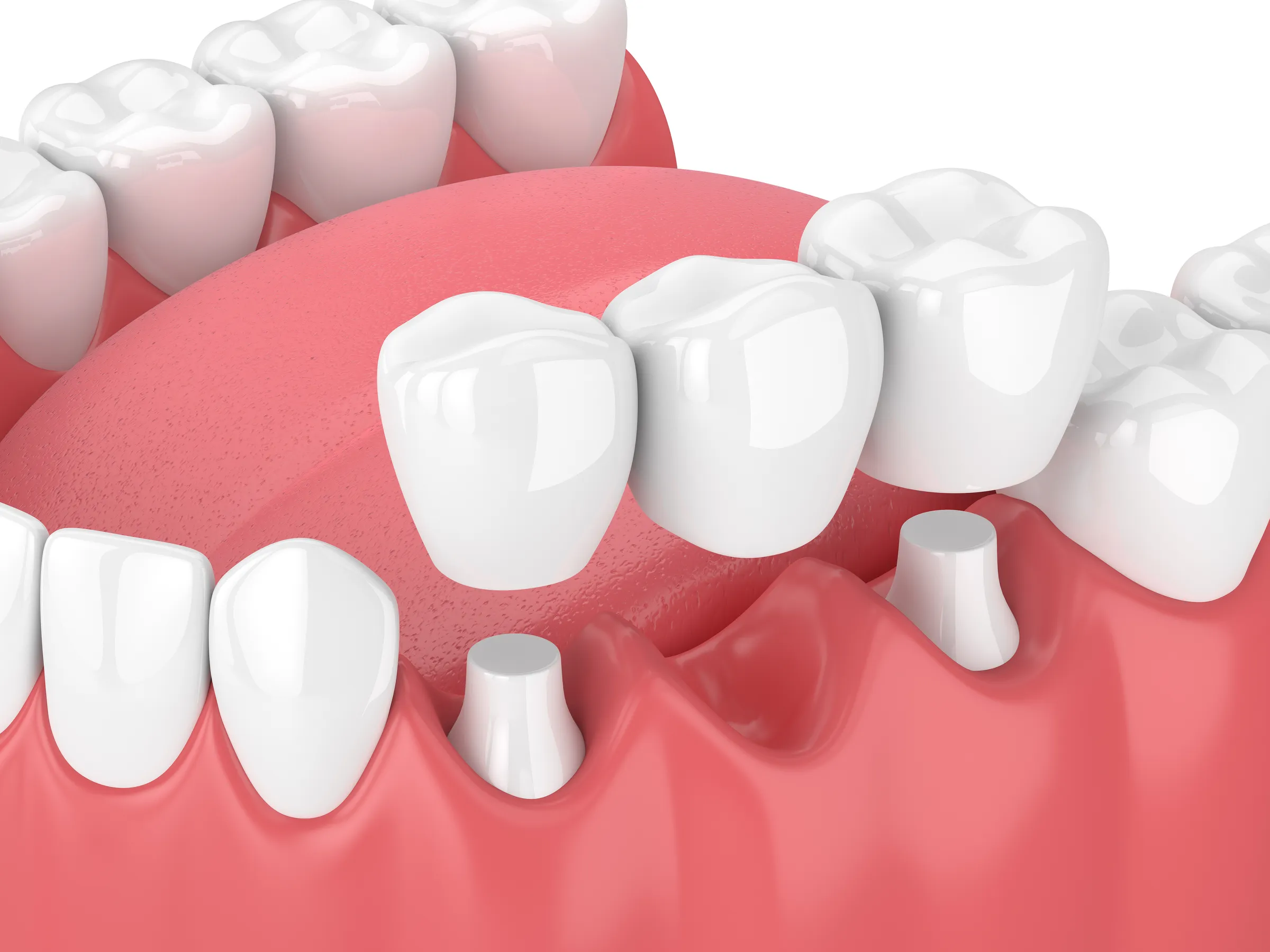 Illustration of a lower jaw with an implant abutment where a tooth is missing