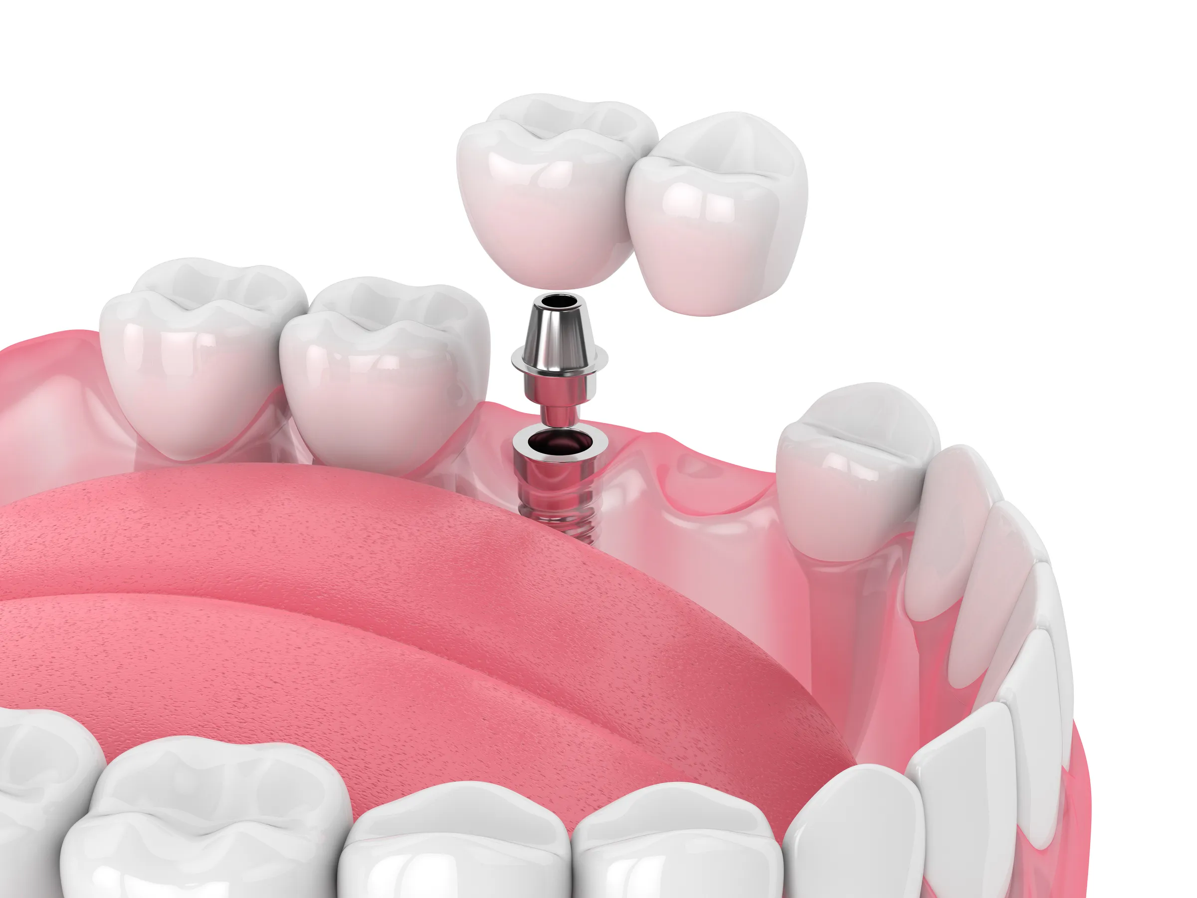 Illustration of a crown being lowered onto a dental implant