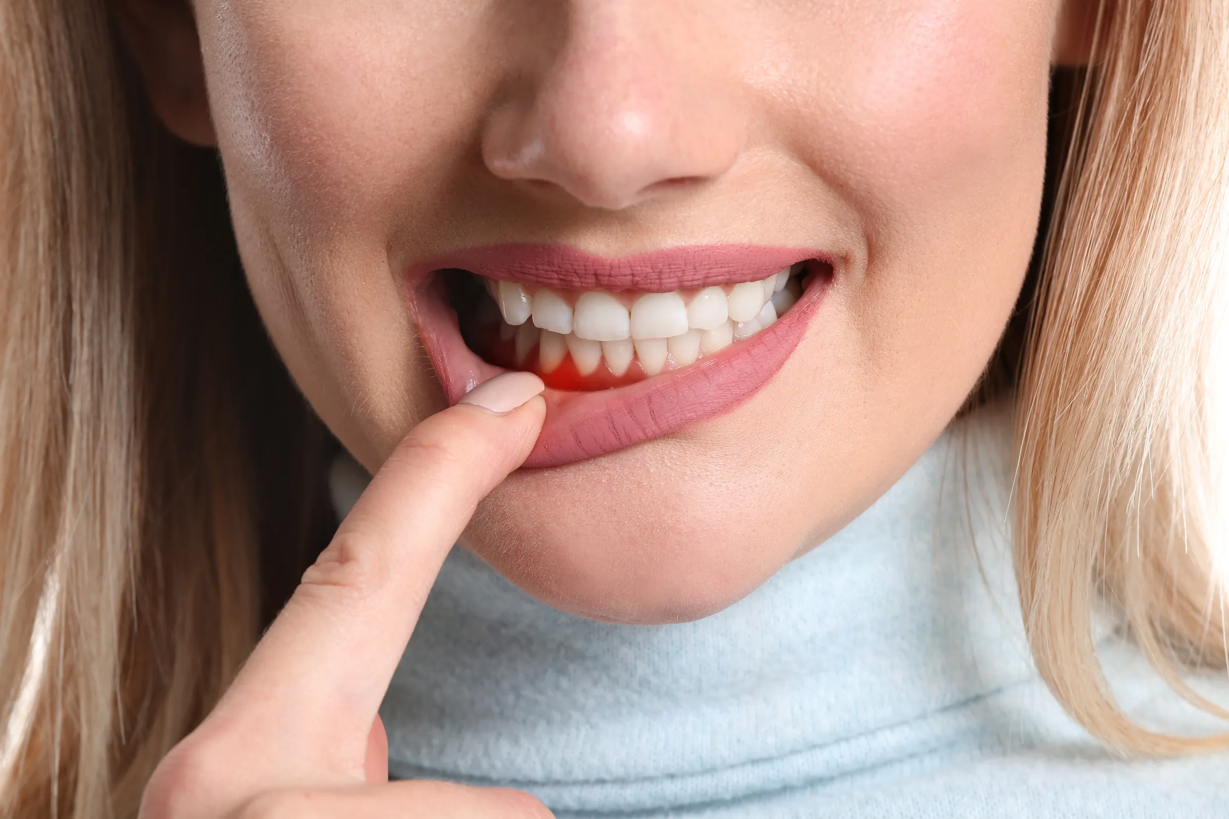 A woman pointing to red, inflamed gum tissue above her front teeth