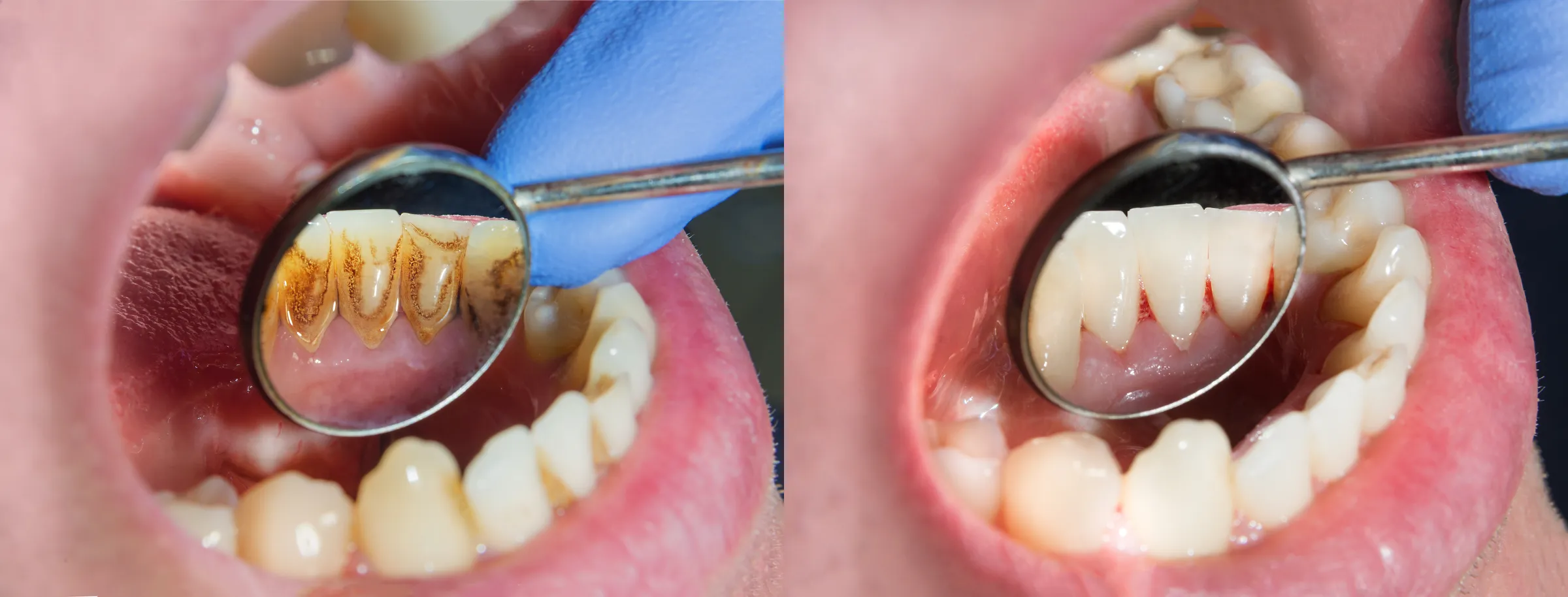 Two mirror views of the same lower teeth, before and after tartar removal