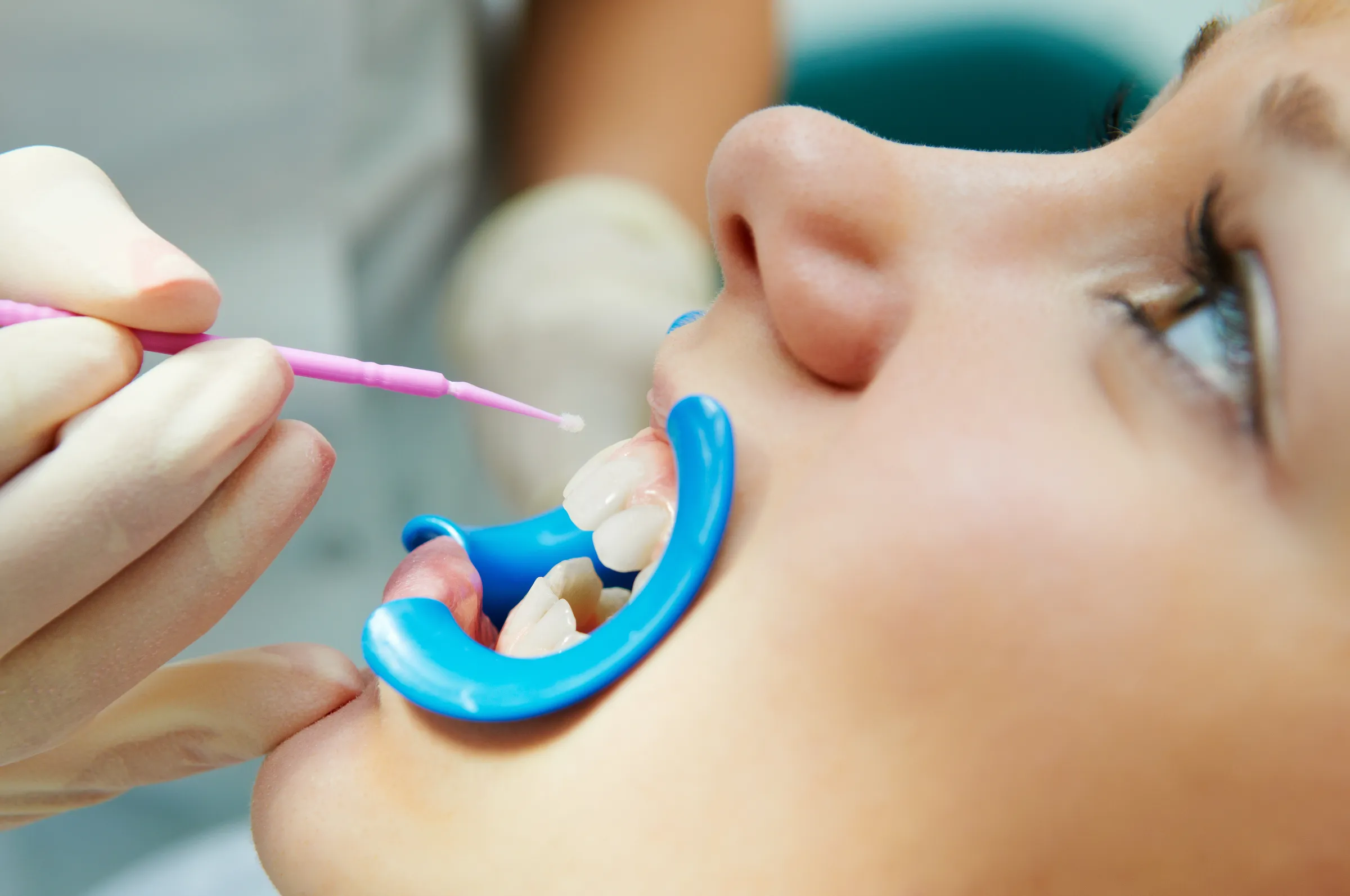 A sealant being applied to a child's tooth with a cheek retractor in place