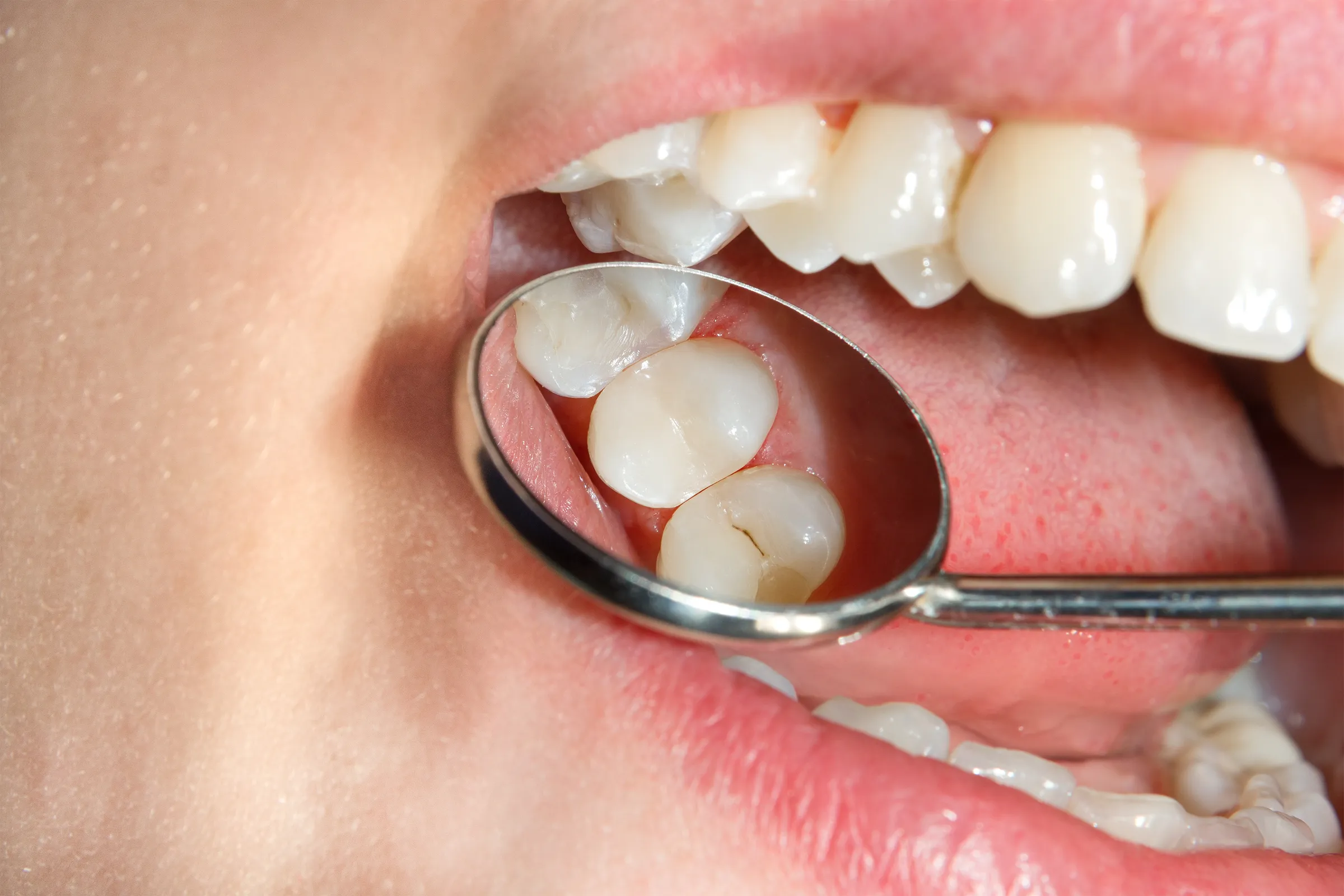 Mirror view of back teeth with sealants in place