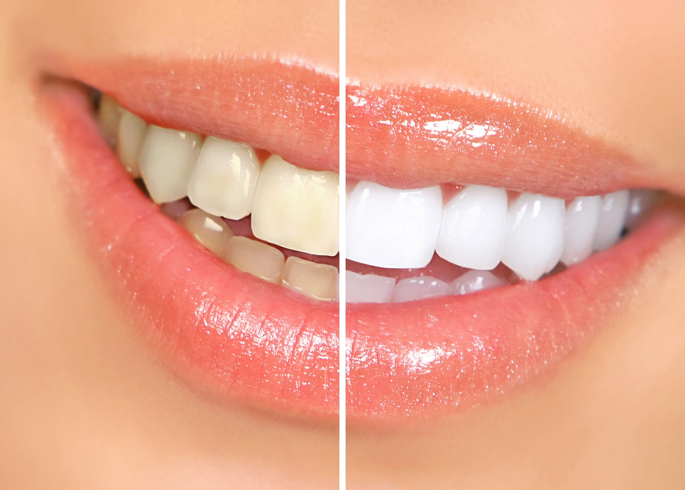Side-by-side comparison of a smile before and after cosmetic treatment