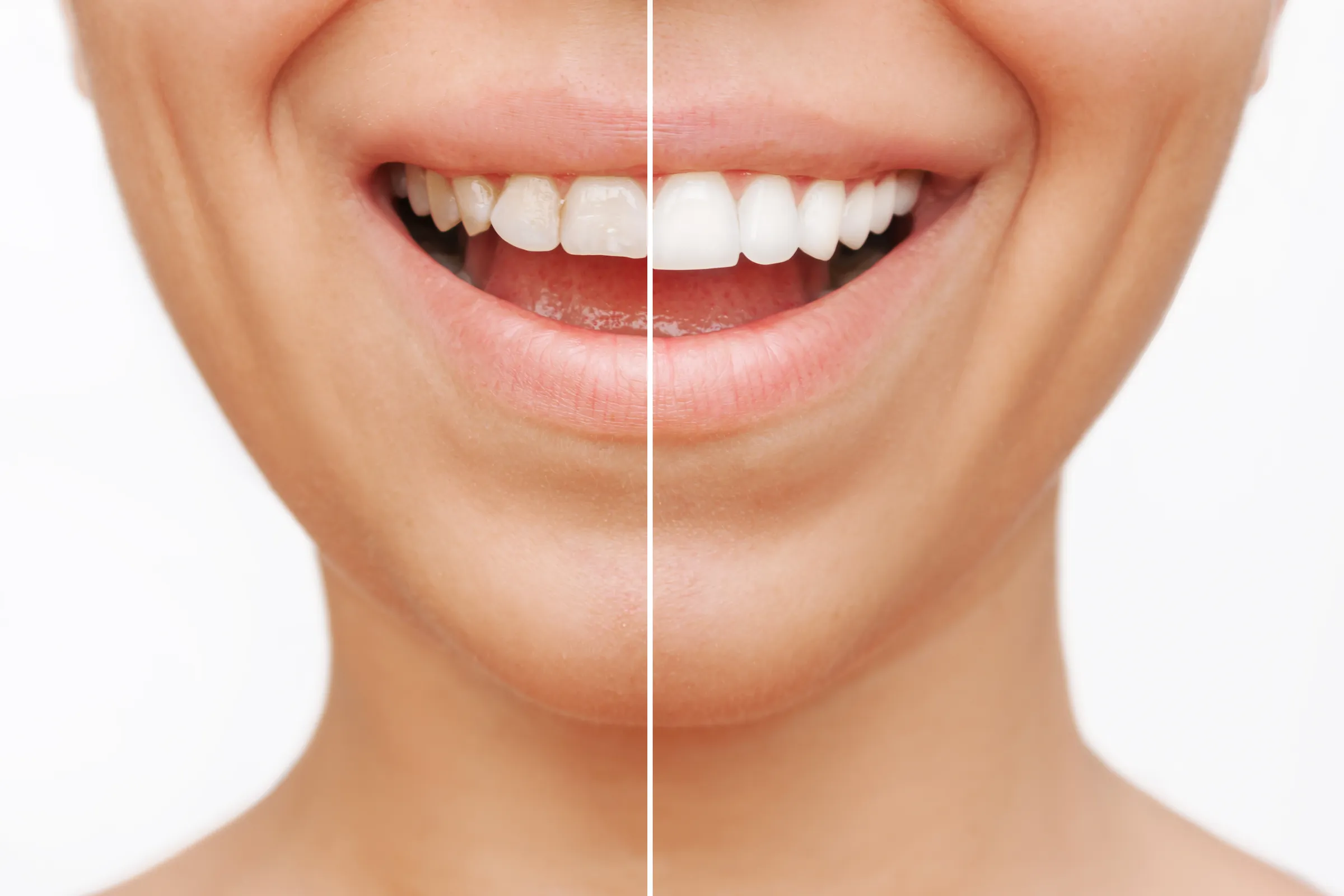 Side-by-side comparison of a smile before and after a smile makeover
