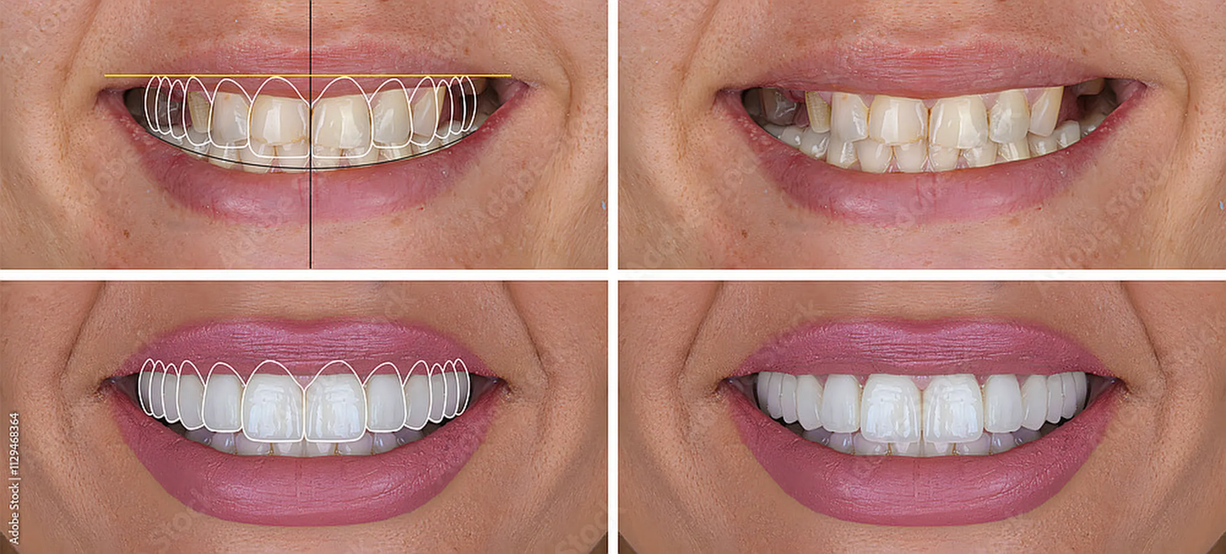 Four stages of a smile transformation, from braces through to the finished result